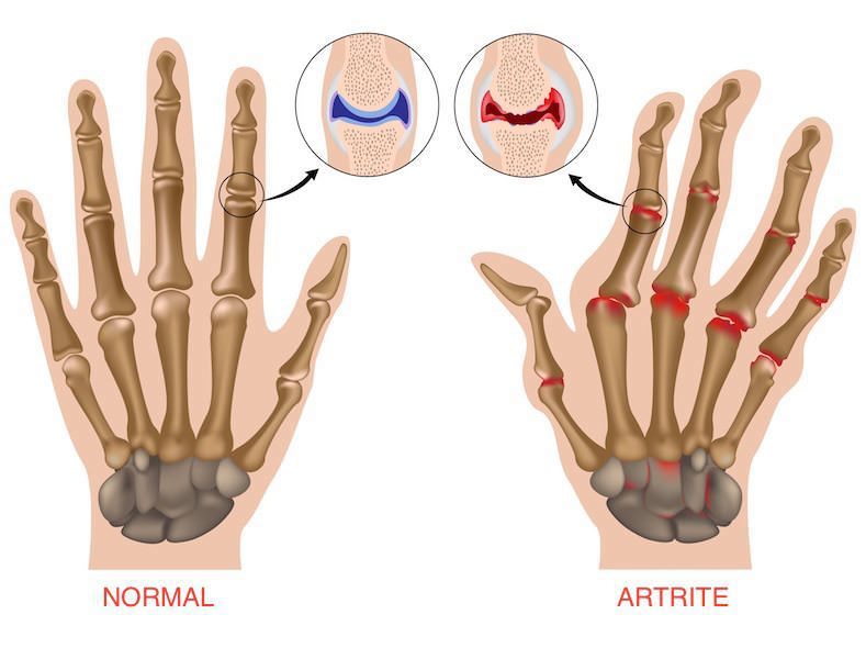 artrite